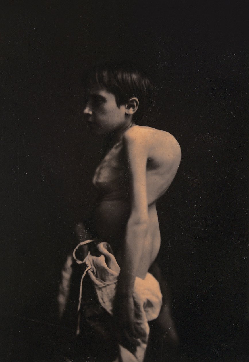 Porträtt av en puckelpojke, ca 1855-57 av Guillaume Benjamin Armand Duchenne de Boulogne