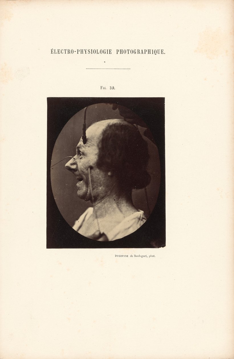 Fotografisk elektrofysiologi, figur 39 av Guillaume Benjamin Duchenne