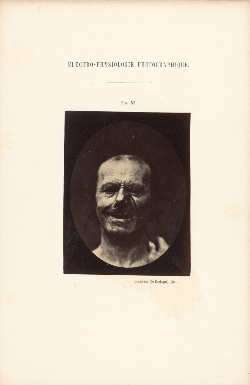 Fotografisk elektrofysiologi, figur 53 av Guillaume Benjamin Duchenne