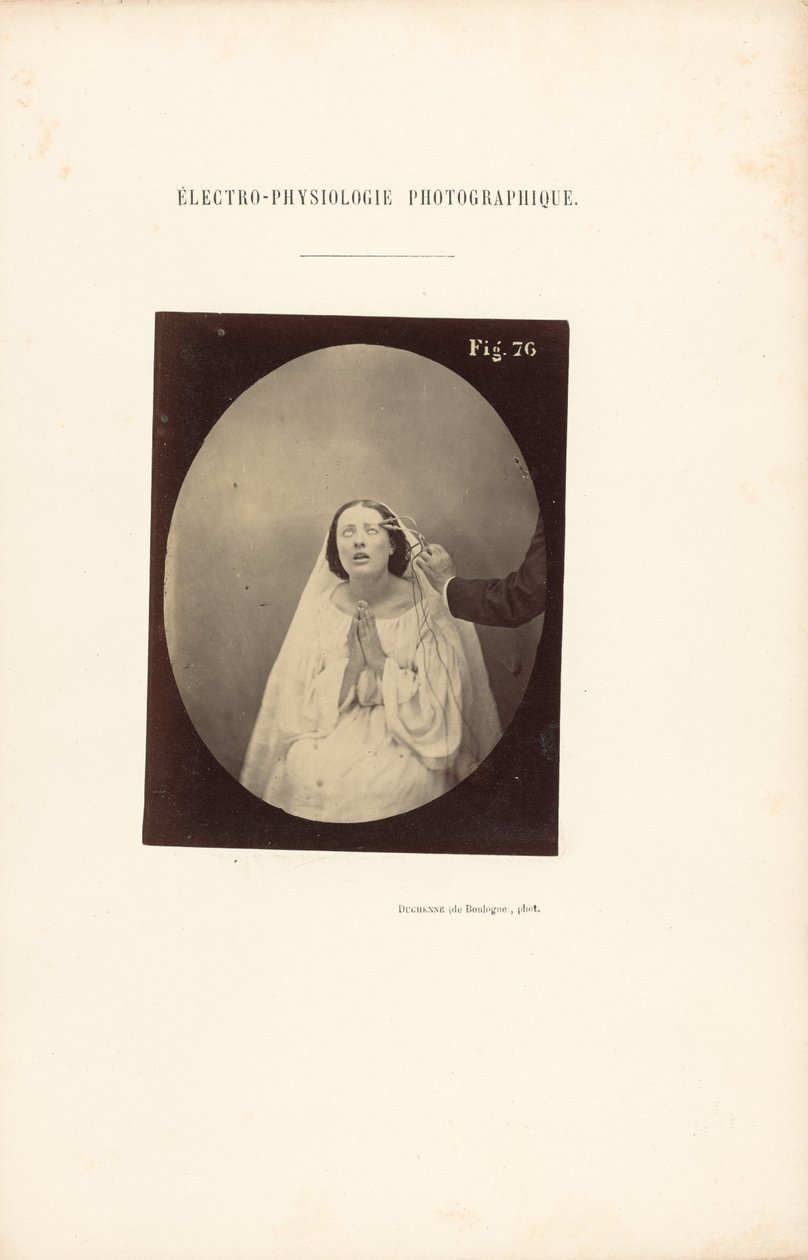 Fotografisk elektrofysiologi, figur 76 av Guillaume Benjamin Duchenne