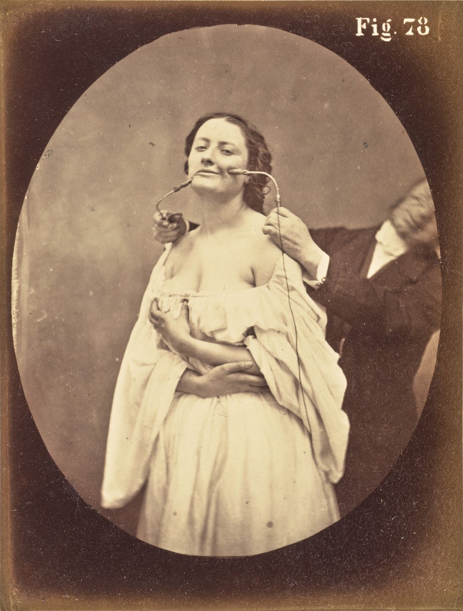 Fig. 78 av Guillaume Benjamin Duchenne