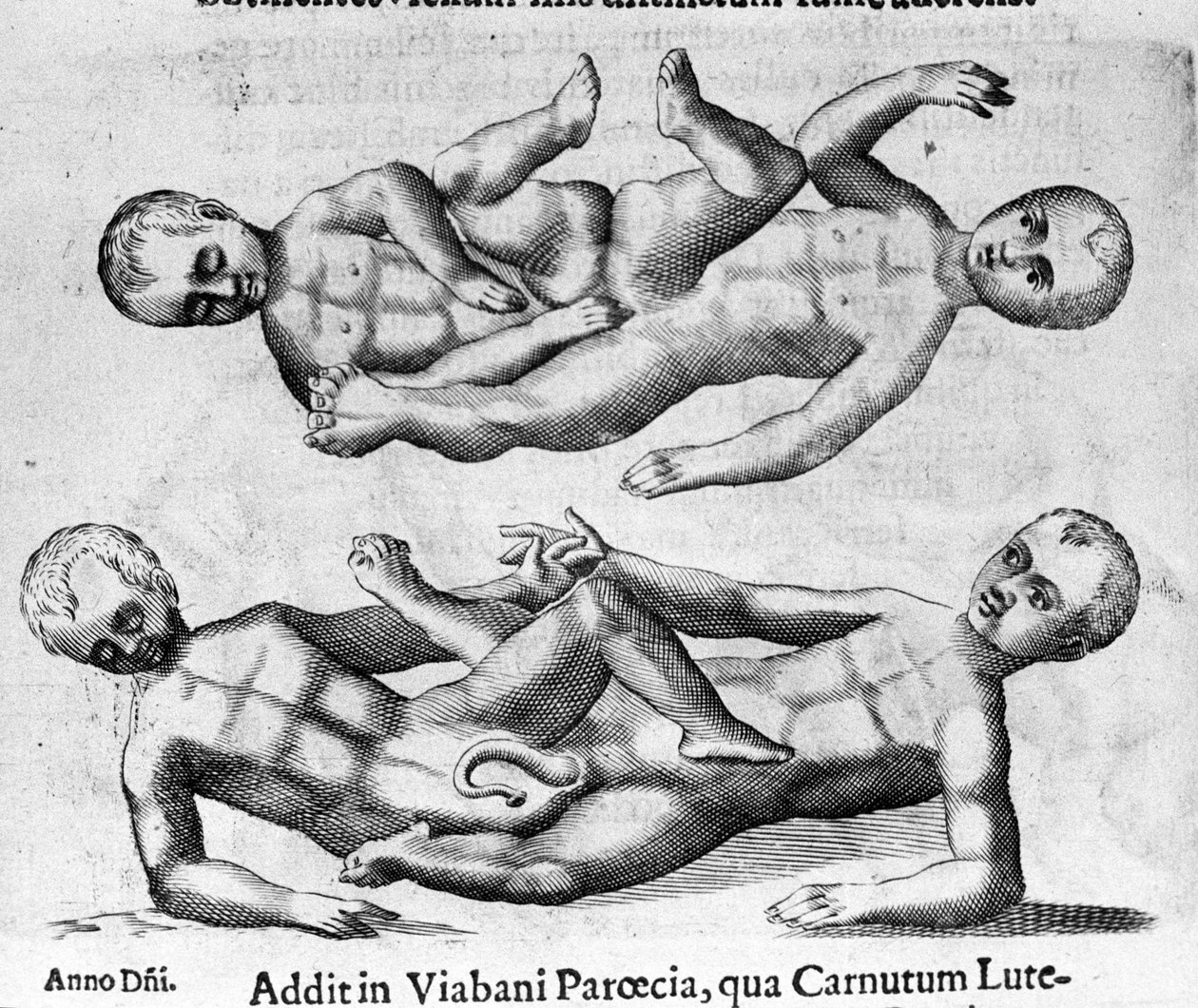 Olika typer av människomonster: Siamesiska barn sammankopplade med bäckenet. Gravyr från "Monstrens natur, deras orsaker och skillnader" av Fortunio Whilei (1577-1656), italiensk vetenskapsman. 1646 av Italian School