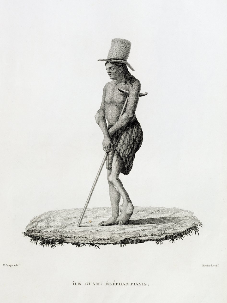 Guam: A Man with Elephantiasis, från 