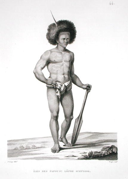 Papuaöarna: Spetälska offer, från "Voyage Autour du Monde (1817-20)", av Louis Claude Desaulses de Freycinet (1779-1842), graverad av Forget, publicerad 1822-24 (litografi). av Jacques Etienne Victor (after) Arago