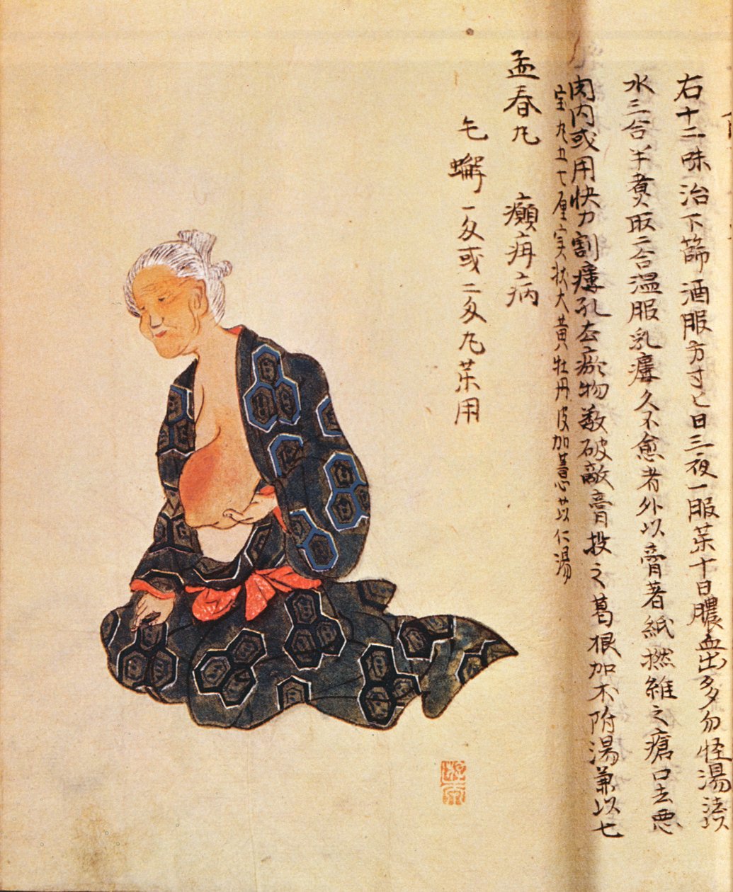 Den första kirurgiska behandlingen av bröstcancer utförd under allmän narkos av Seishu Hanaoka (1760-1836) 1804 av Japanese School