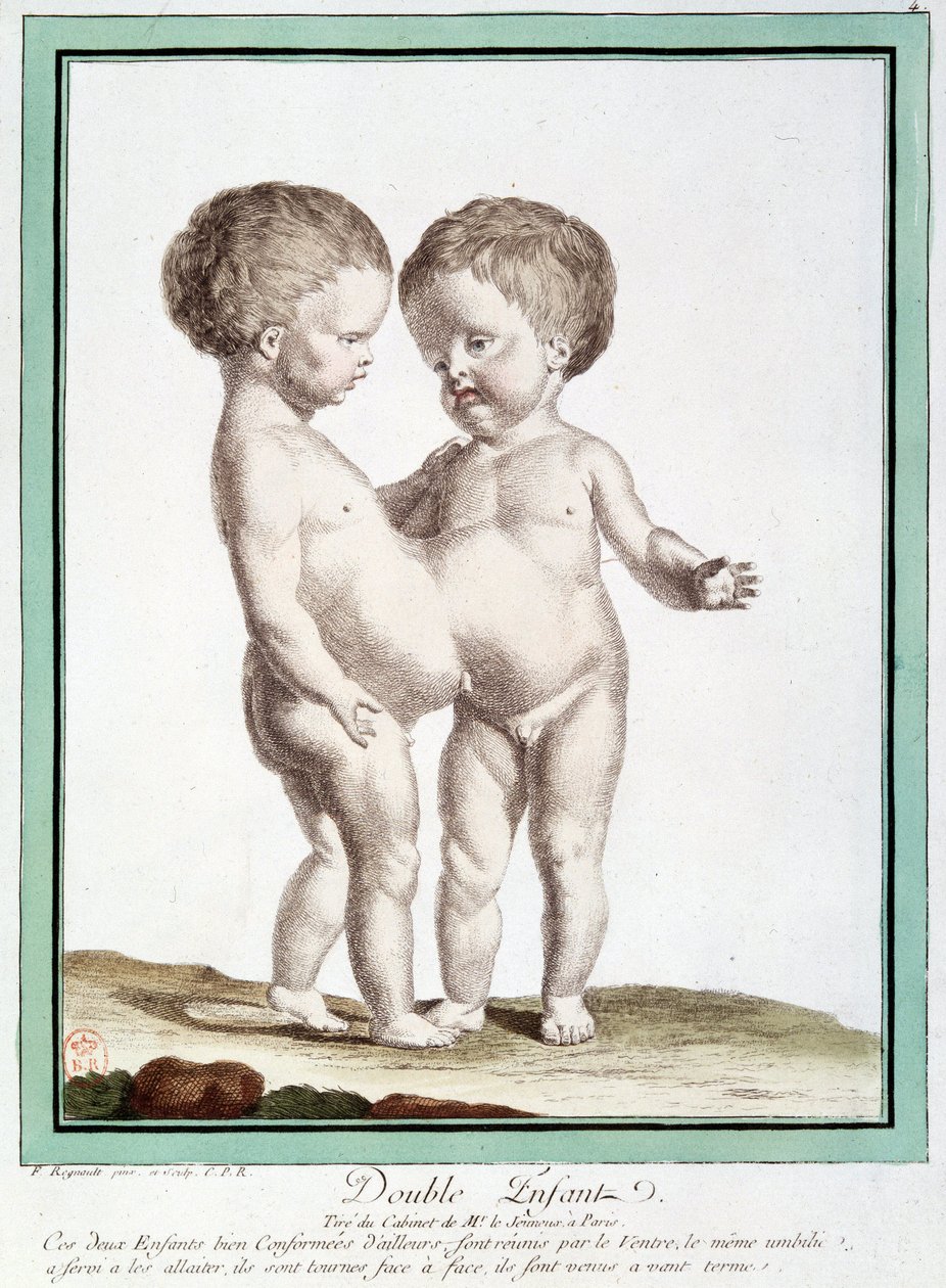 Siamesiska barn - i "" Naturens avvikelser"" av Régnault av Jean Baptiste Regnault