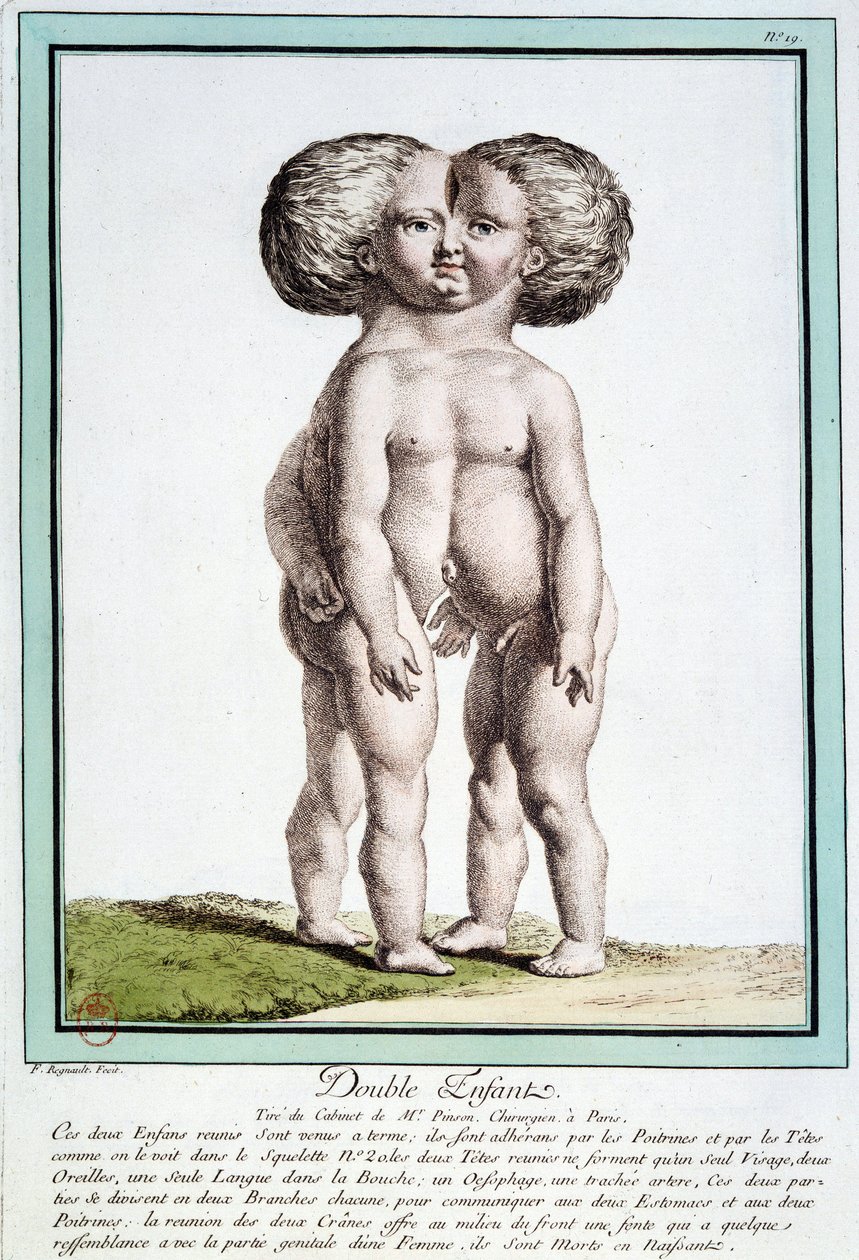 Siamesiska barn - i "" Naturens avvikelser"" av Régnault av Jean Baptiste Regnault