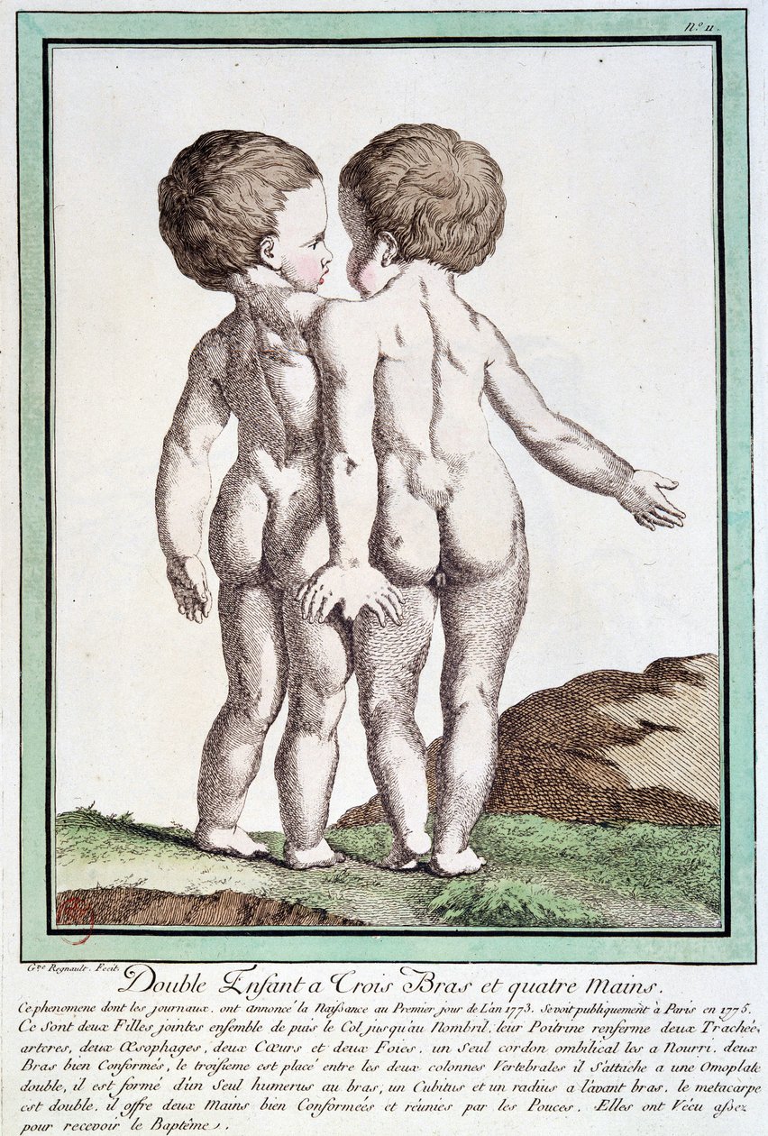 Siamesiska barn - i "" Naturens avvikelser"" av Régnault av Jean Baptiste Regnault