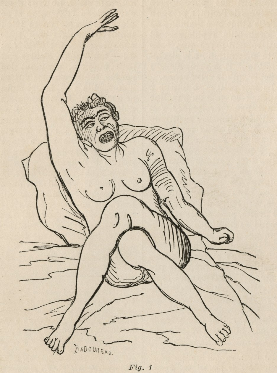 Hysterisk epilepsi, attack, vridningar, fig. 1 från 