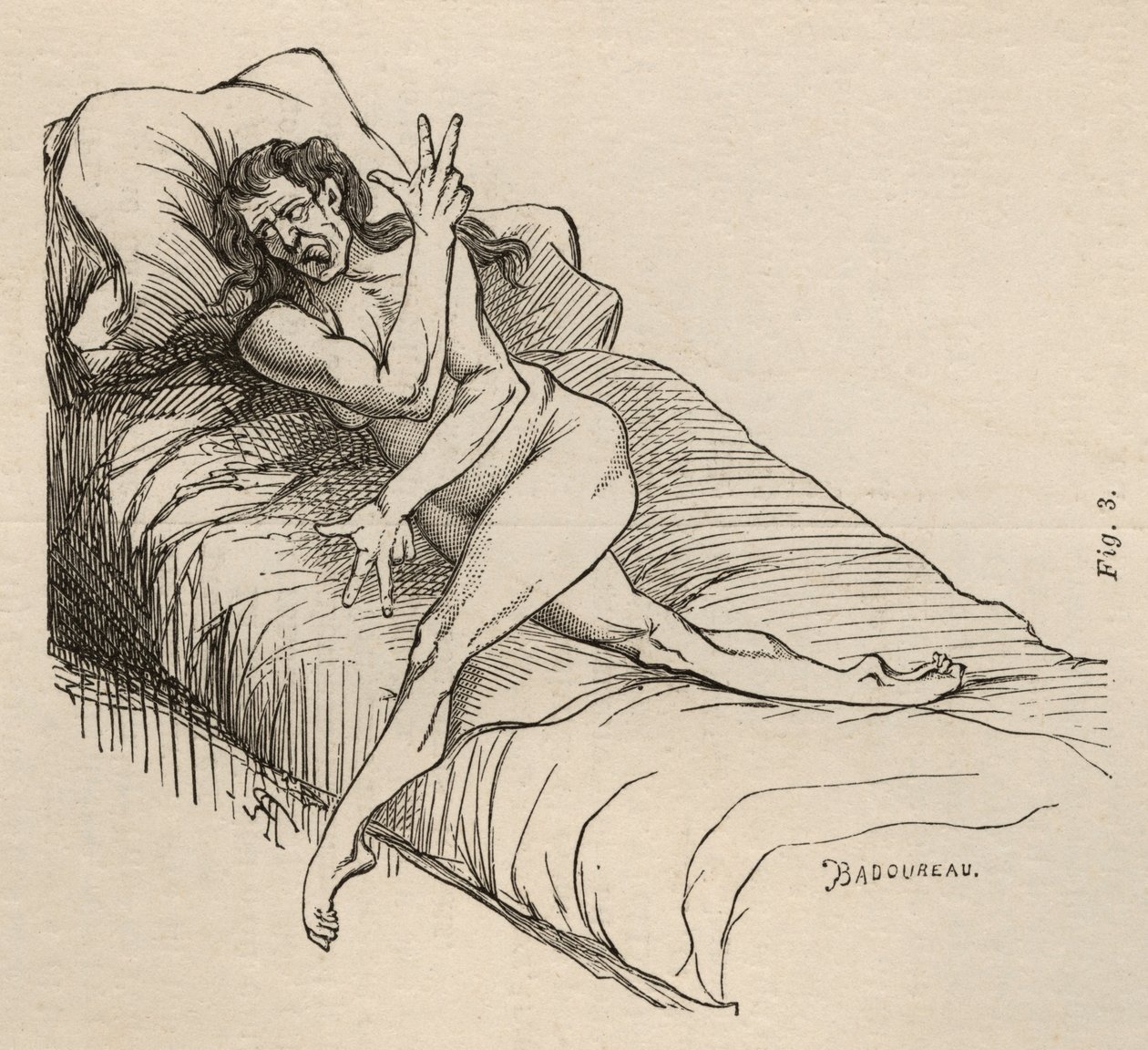 Hysterisk epilepsi, attack, vridningar, fig. 3 från 
