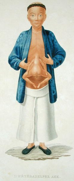 Kinesisk man med en outvecklad sammanfogad tvilling fäst vid buken, illustration från en fransk resebok, graverad av M. Legrand (färgad gravyr) av Jean Gabriel (after) Pretre