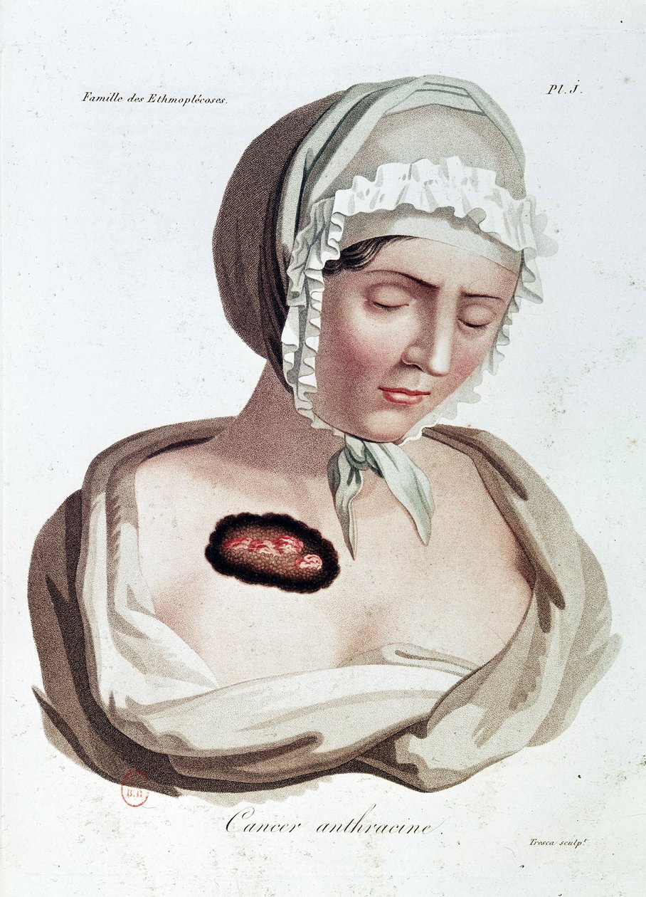 Antracin cancer - Alibert, B.N. av Jean Louis Alibert
