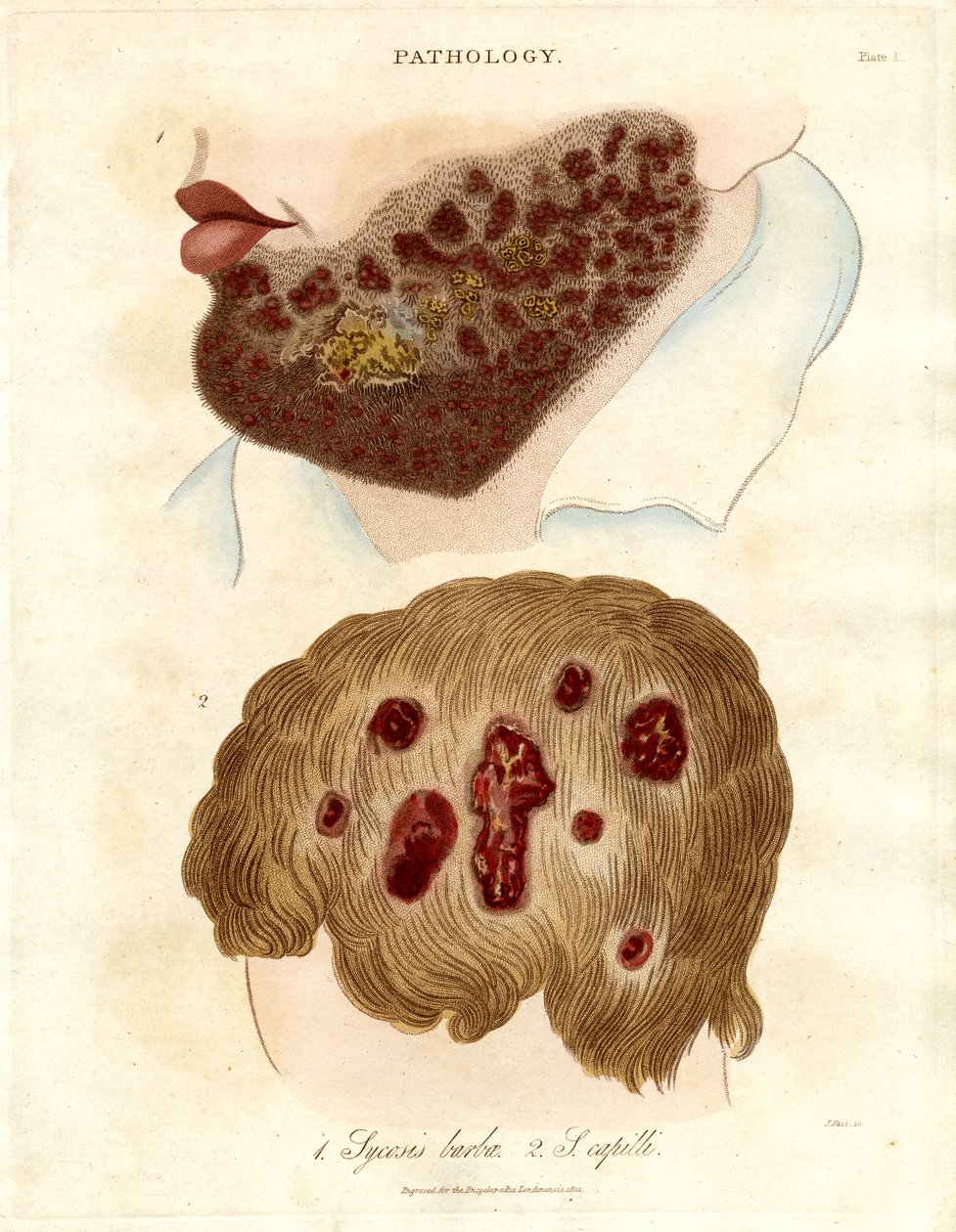 Patologisk illustration av Sycosis barbae och Sycosis capilli av John Pass