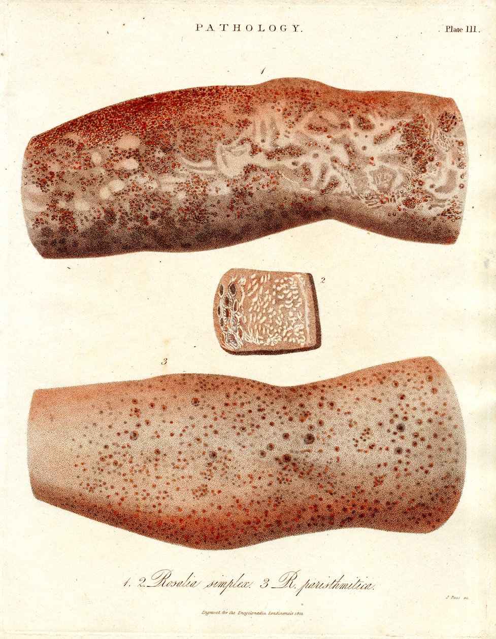 Hudutslag - Roseola simplex och Roseola paristhmitica av John Pass