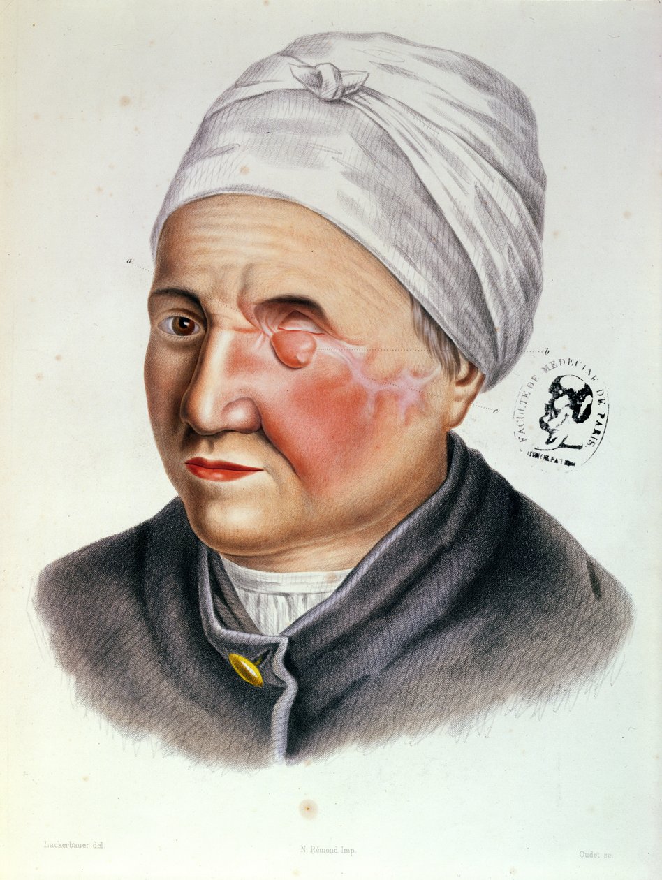 Illustration från Traite de Chirurgie Plastique av Antoine Jobert de Lamballe (1799-1867) Paris, 1849 av Lackerbauer