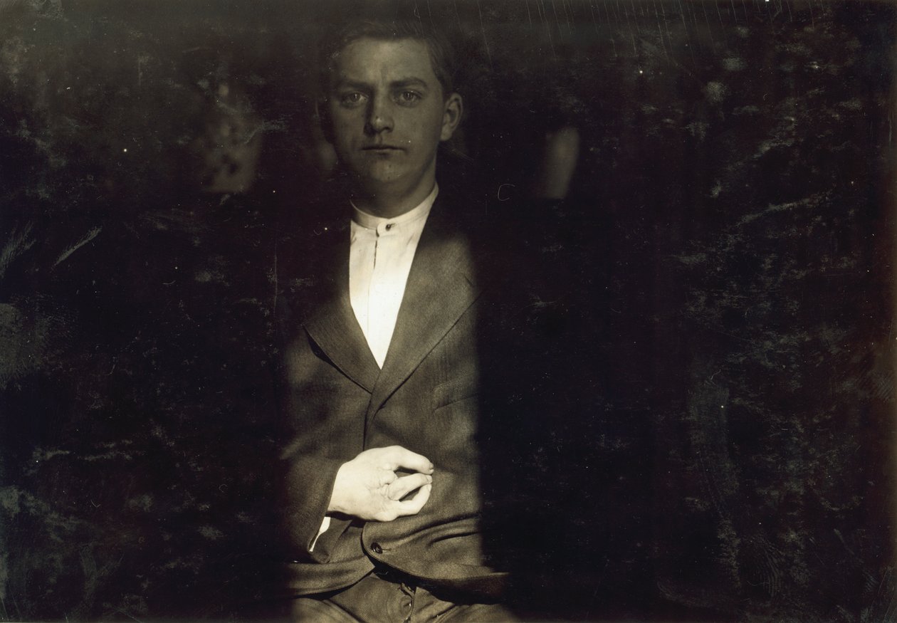 Frank Wiegel från Brooklyn, skadad efter att ha arbetat 18 timmar om dagen vid 15 års ålder, två fingrar amputerades av hans högra hand, New York City av Lewis Wickes Hine