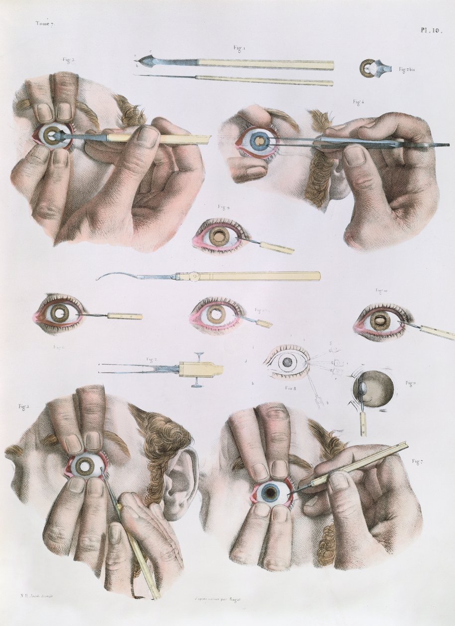 Operation on a eye, tallrik från 
