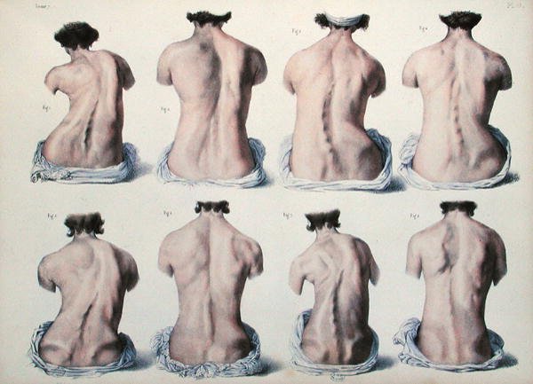 Spinal deformities, tallrik från 