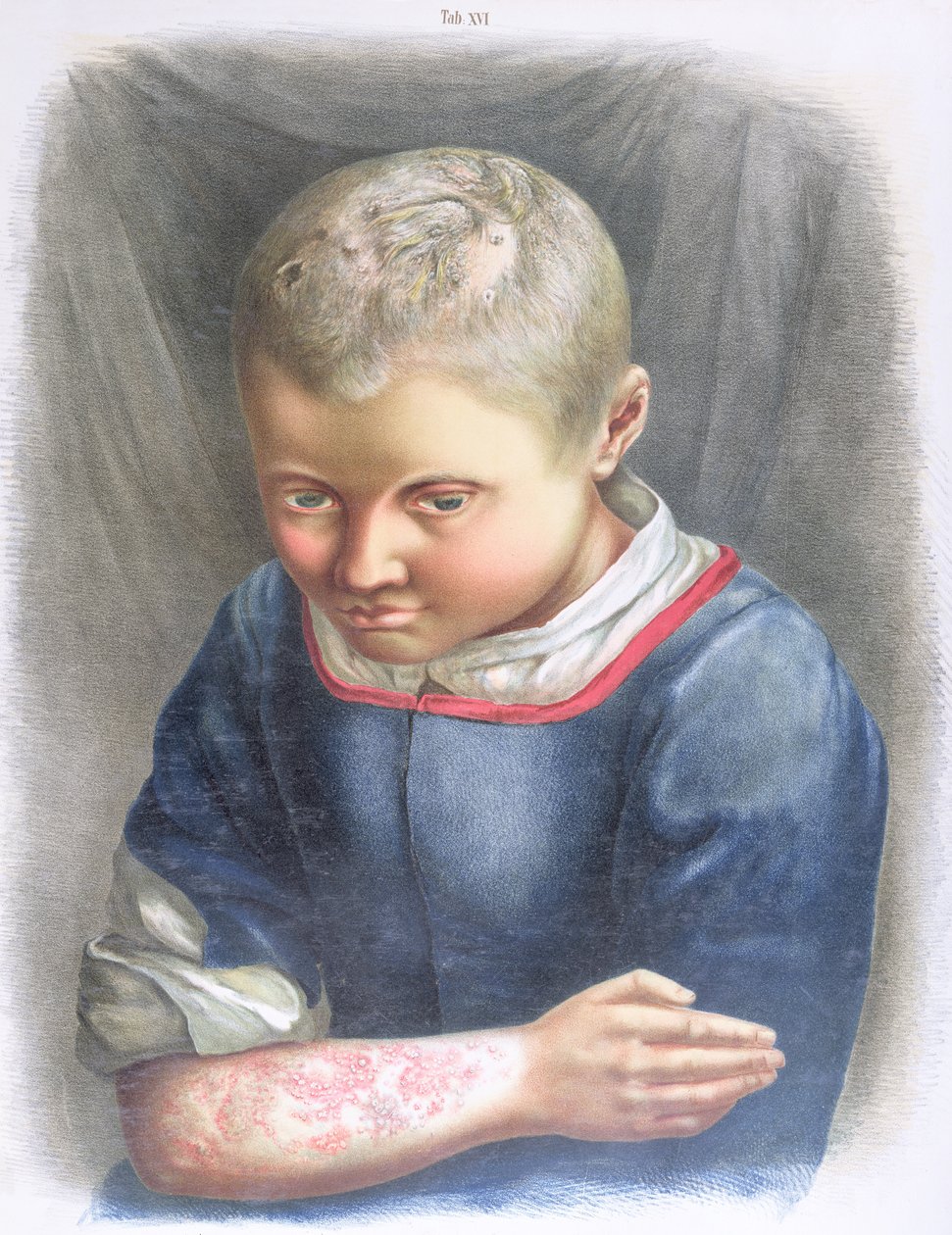 Favus, från en bok av Daniel Cornelius Danielssen (1815-94) 1892 av Norwegian School