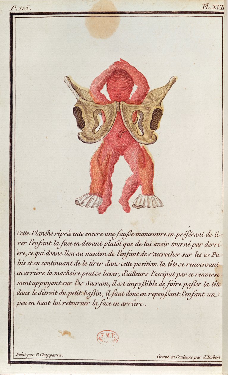 Tvärsnittsdiagram av en bebis dragen från livmodern av benen, från en bok av Madame Angelique Le Boursier du Coudray (1714-94) graverad av J. Robert, 1783 av P. Chapparre
