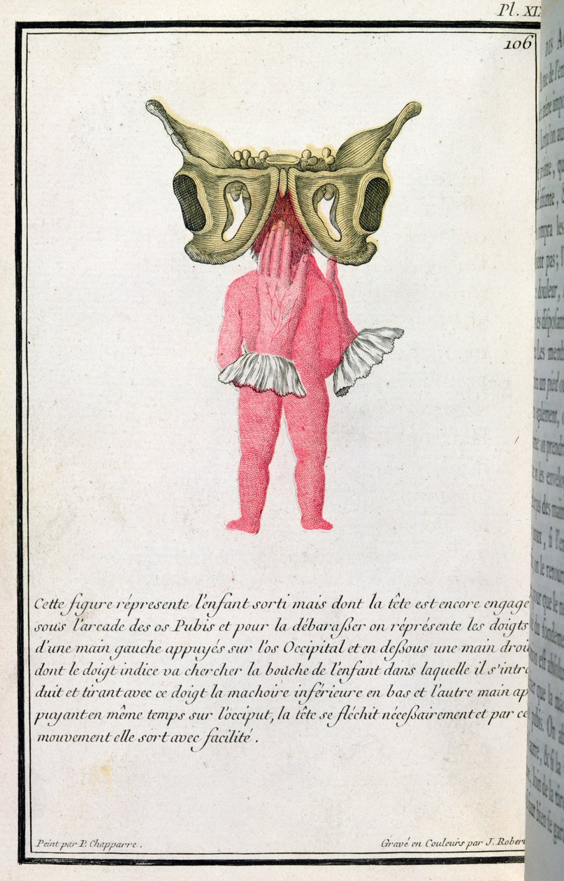 Tvärsnittsdiagram av en baby som dragits ur livmodern, från en bok av Madame Angelique Le Boursier du Coudray (1714-94) graverad av J. Robert, 1783 av P. Chapparre