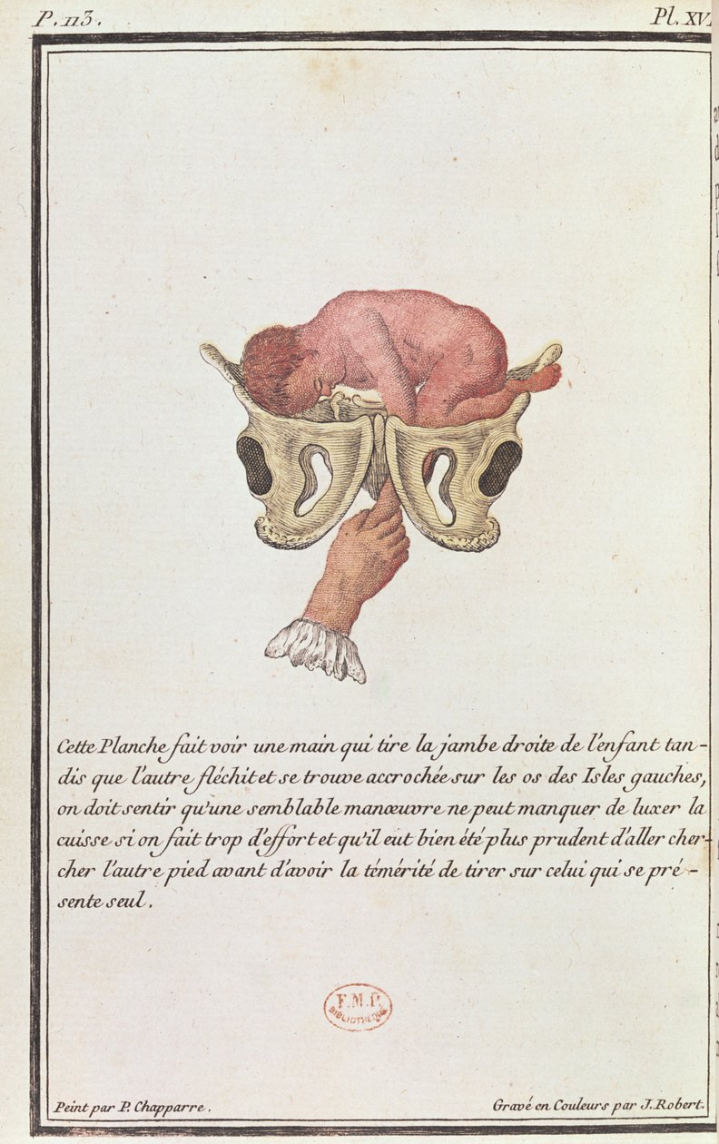 Tvärsnittsdiagram av en baby som dragits från livmodern med armen, från en bok av Madame Angelique Le Boursier du Coudray (1714-94) graverad av J. Robert, 1783 av P. Chapparre