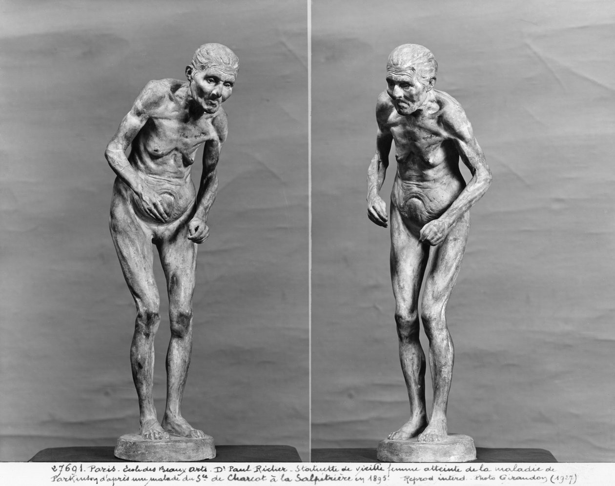 Statyett av en gammal kvinna med Parkinsons sjukdom, efter 1895 (gips) av Paul Marie Louis Pierre Richer