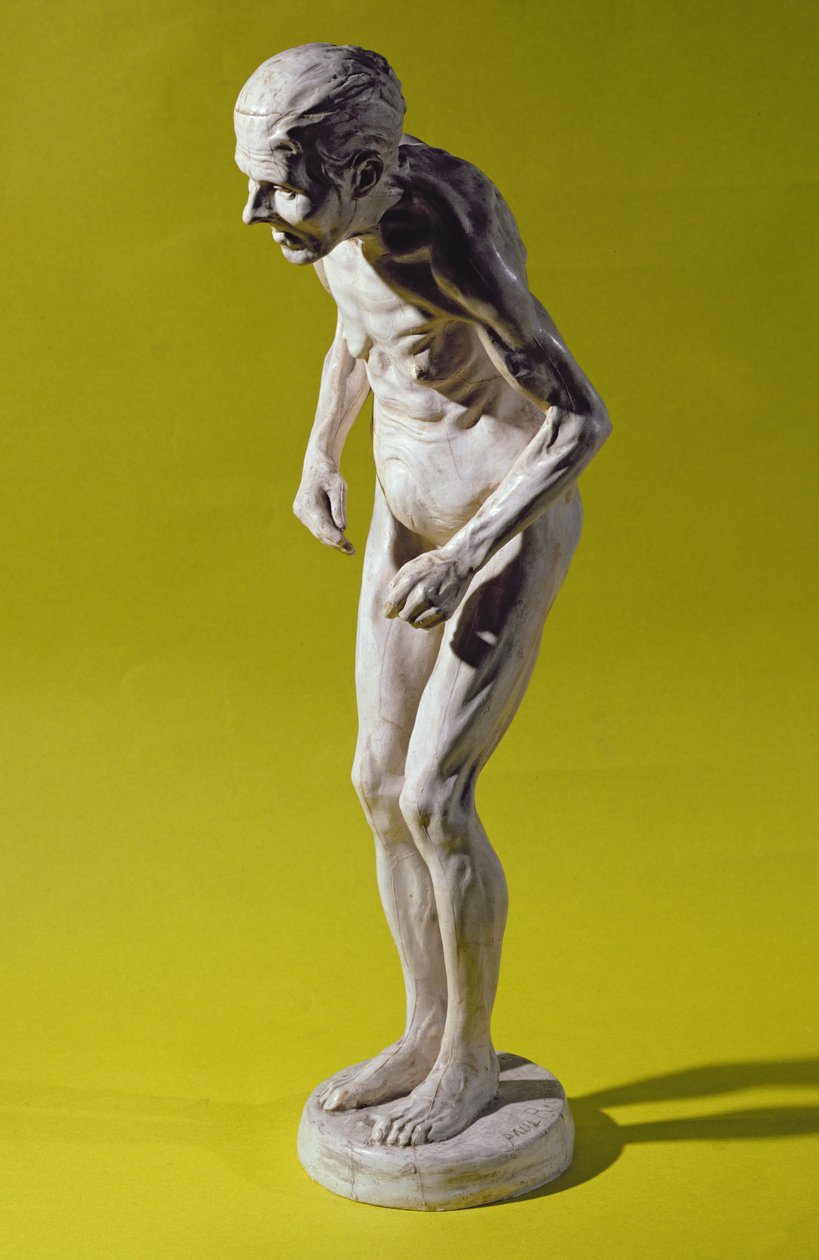 Figur av en kvinna med Parkinsons sjukdom (gips) av Paul Marie Louis Pierre Richer