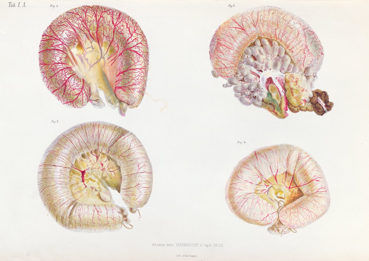 Den yttre ytan av tarmarna infekterade med kolera, från Anatomie Pathologique du Cholera Morbus, av Nikolai Ivanovich Pirogov (1810-81) publicerad i St. Petersburg, 1849 av Russian School
