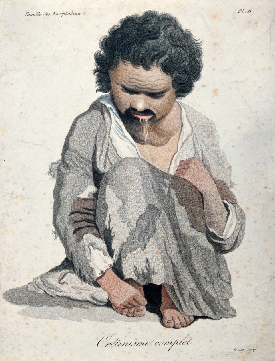 Total kretinism, från en bok av Baron Jean Louis Alibert (1768-1837) av Salvadore Tresca
