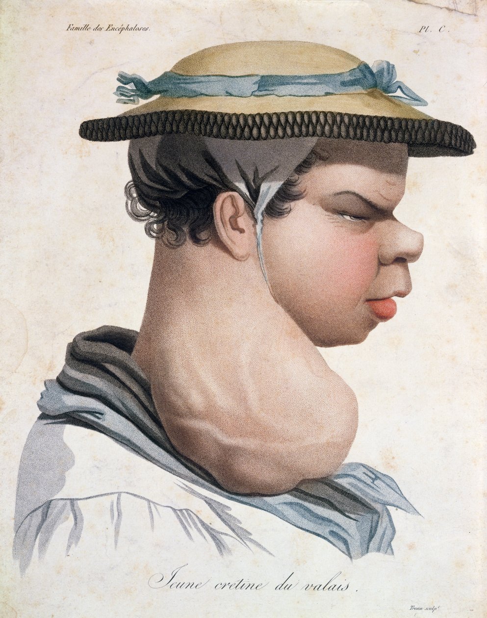 Young Cretin från Valais, illustration från en bok av Baron Jean Louis Alibert (1768-1837) av Salvadore Tresca