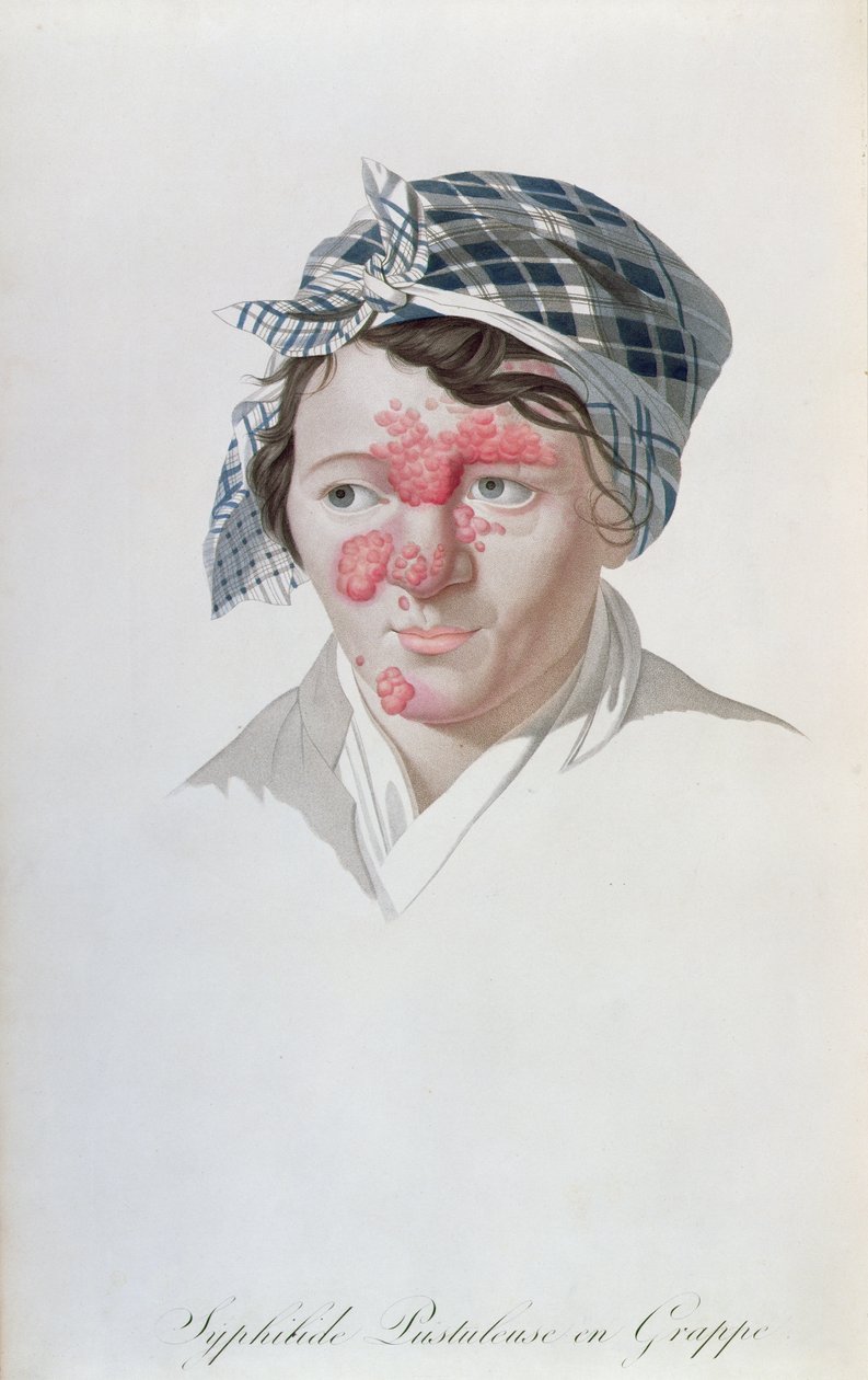 Syfiliska klusterpustler, från en bok av Baron Jean Louis Alibert (1768-1837) 1838 av Salvadore Tresca