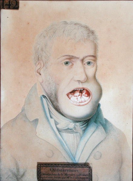 Osteosarkom i underkäken, framgångsrikt opererad av Guillaume Dupuytren (1777-1835) (penna på papper) av School French