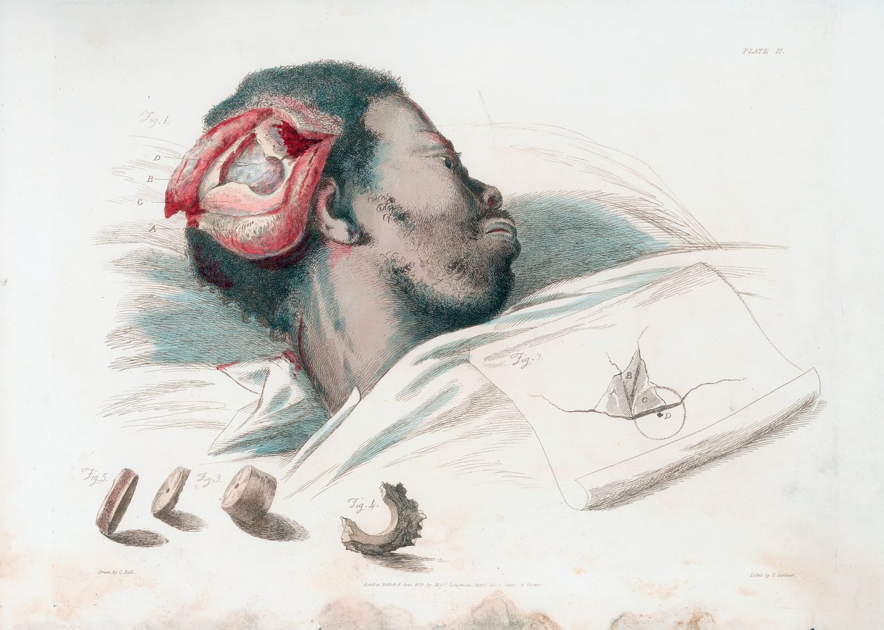 Vy av sår i skallen efter trephination och avlägsnande av krossat benstycke längst ner till vänster, 1821 av Thomas Landseer