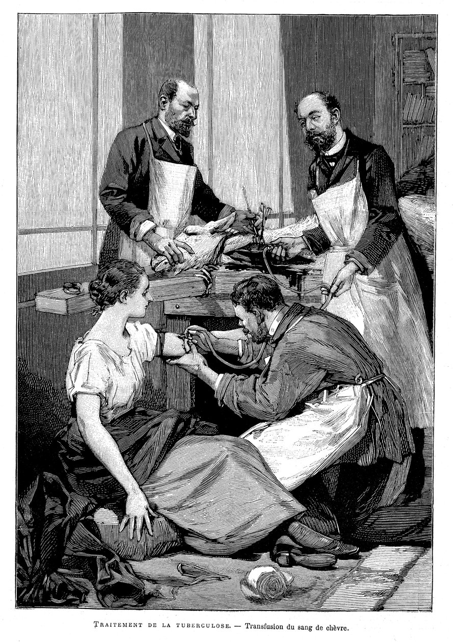 En tuberkulospatient som fick en transfusion av getblod, 1891 av Unbekannt
