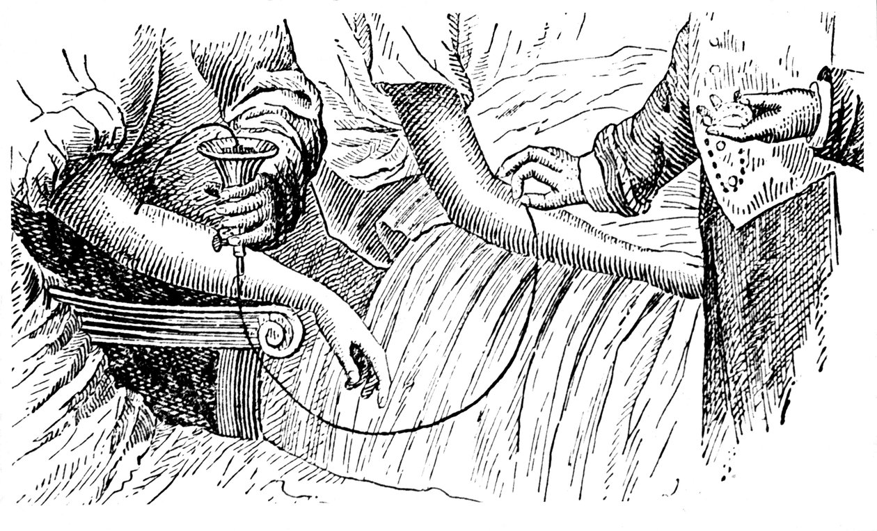 Blodtransfusion, c1880 av Unbekannt