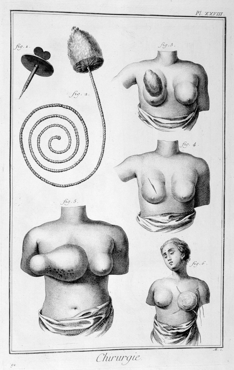 Bröstkirurgi, 1751-1777 av Unbekannt