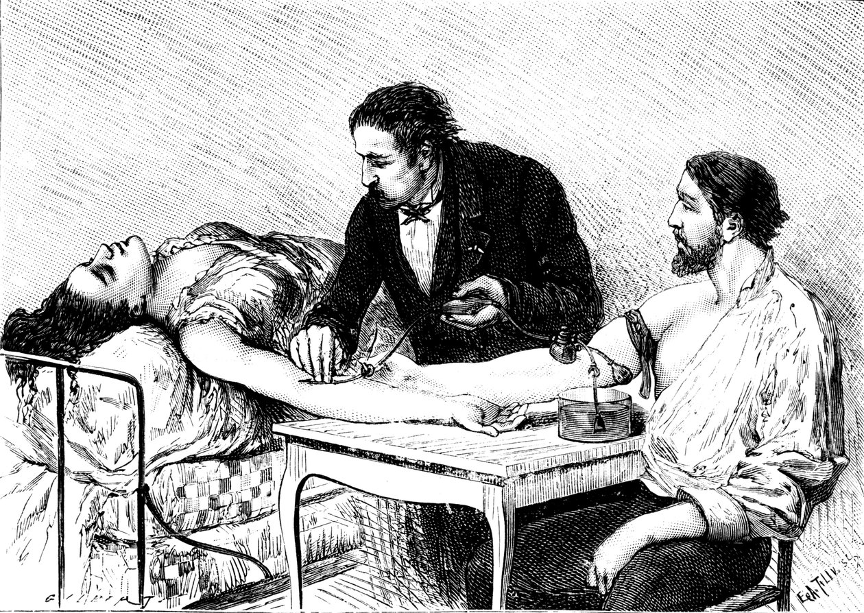 Dr Roussell från Genève gav en kvinna en direkt blodtransfusion från en volontär, 1882 av Unbekannt