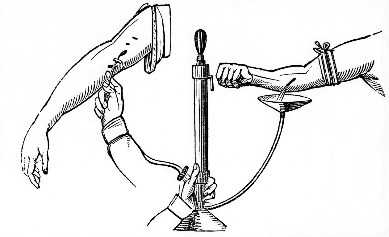 Blodtransfusion från person till person, 1833 av Unbekannt