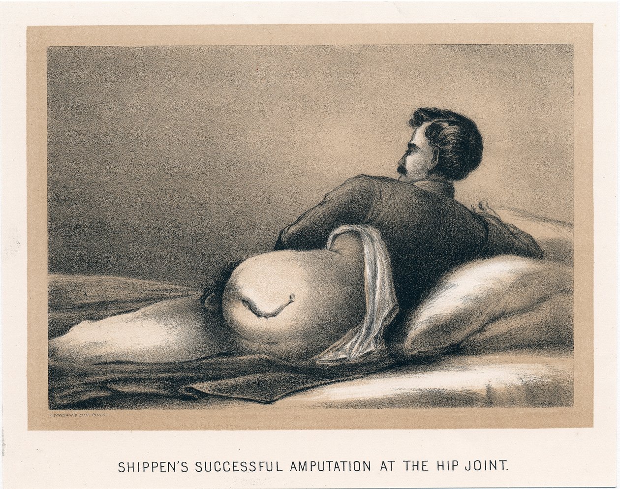 Shippens framgångsrik amputation vid höftleden, amerikanska inbördeskriget, 1865 av Unbekannt