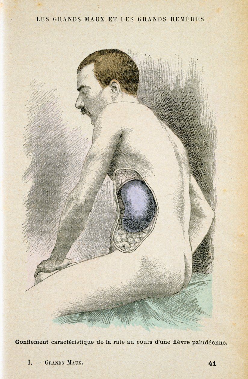 Typisk förstorad mjälte hos en malariapatient, c1890 av Unbekannt