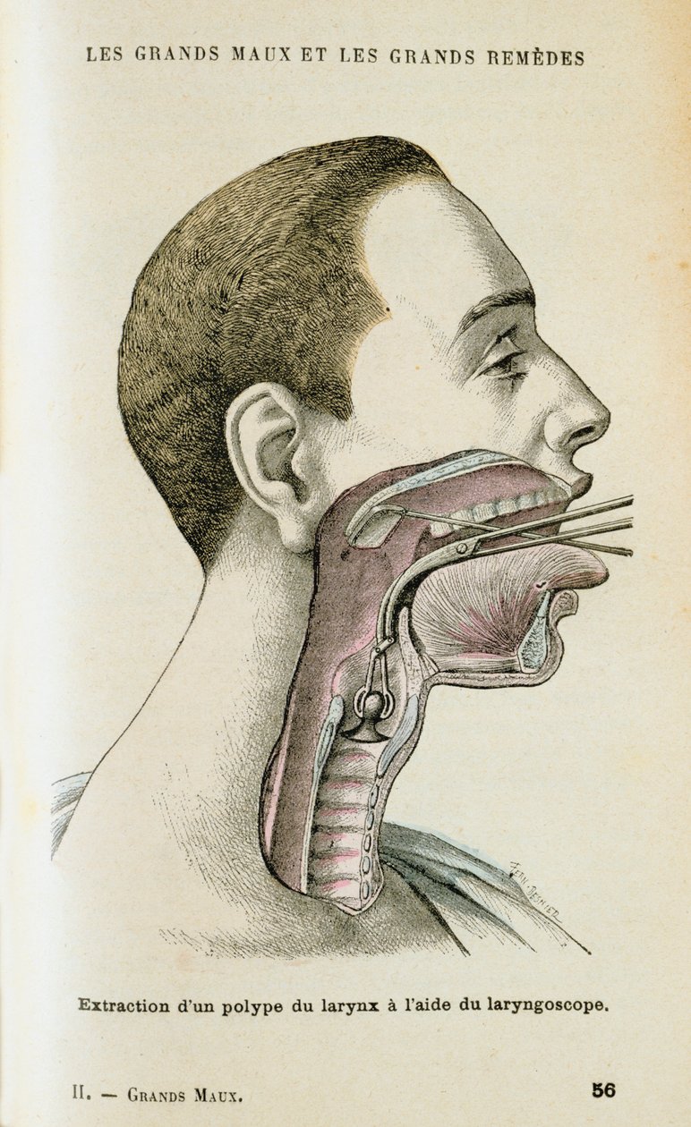 Använda ett laryngoskop för att hjälpa till att ta bort en polyp från halsen, c1890 av Unbekannt