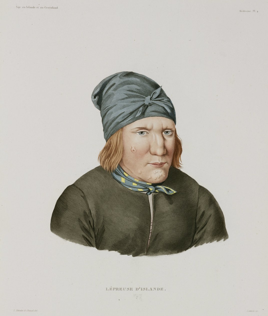 Sjukdomar, spetälska Spetälska, Island, tidigt 1800-tal av Unbekannt