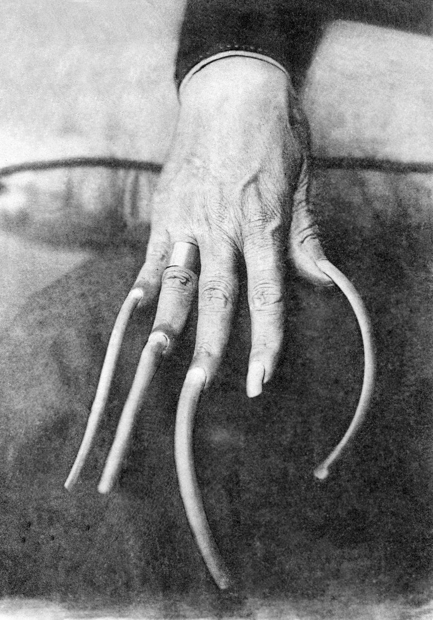Monstruös särprägel: en hand med mycket långa naglar. Kina 1910 om Historiskt foto, långa fingernaglar, Kina, ca 1910 av Unbekannter Künstler