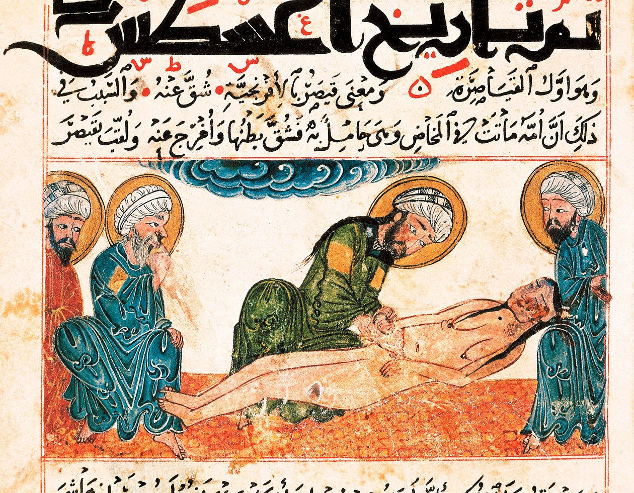 Representation av kejsarsnitt. Miniatyr hämtad från ett medicinmanuskript av Abu Raihan Al-Biruni (eller Alberuni) (973-1048), persisk intellektuell och vetenskapsman, folio 161. av Unbekannt