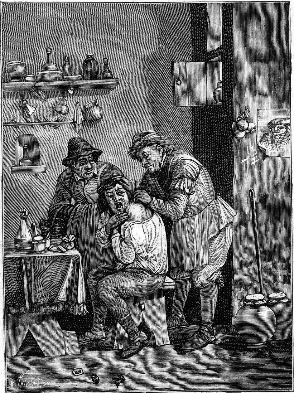 En charlatankirurg på 1700-talet undersöker en axelskada. (Ur en gravering av tiden). Gravyr i "" La Nature: revue des sciences et de leurs applications aux arts et a l