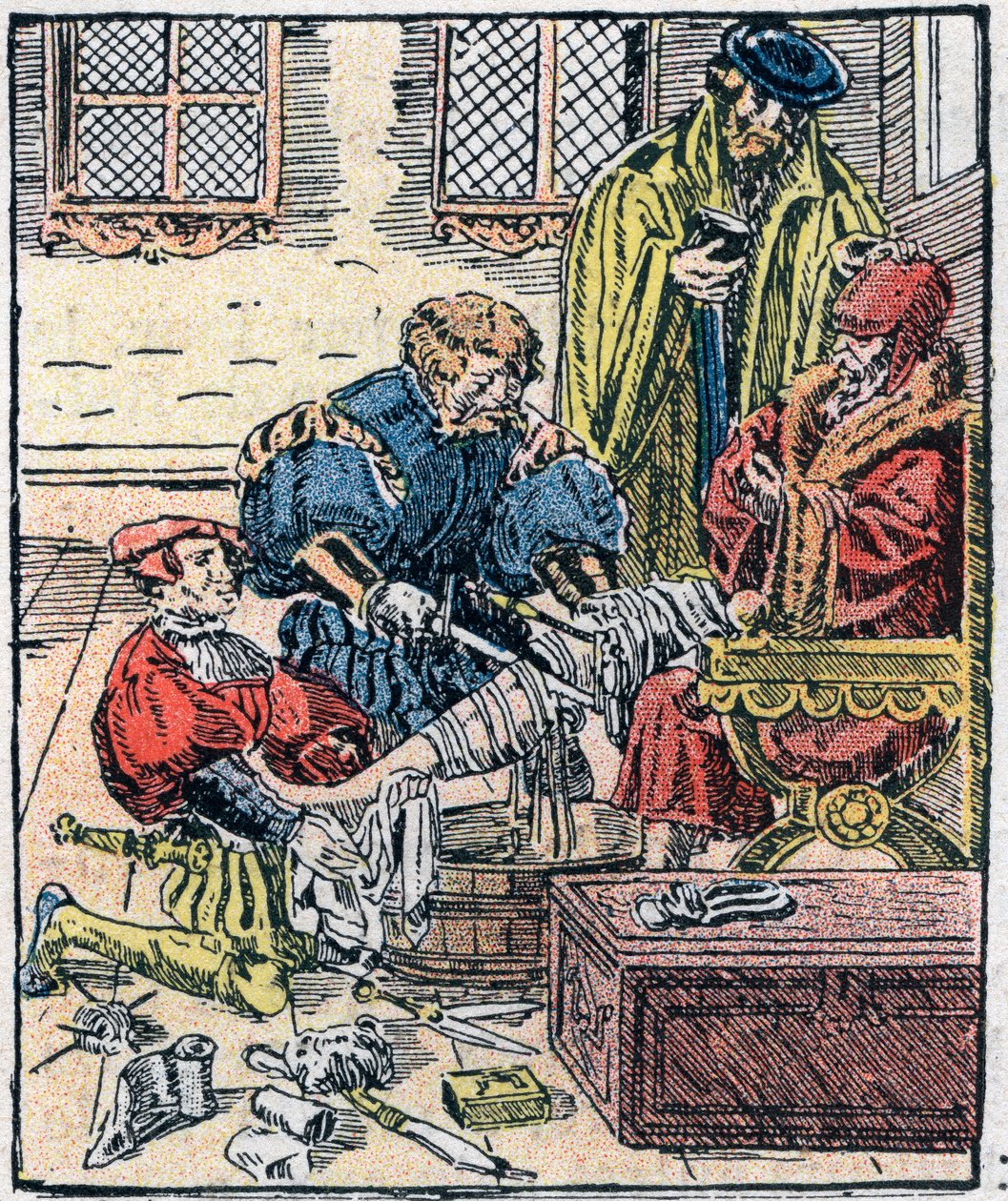 Amputation av ett ben på 1500-talet. av Unknown artist