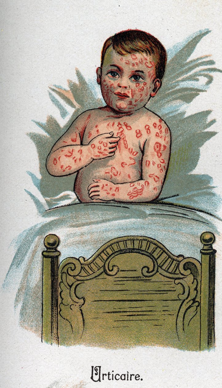 Barns sjukdomar: Nässelutslag. I ”Den nya naturmedicinen”” av F.E. Bilz. av Unknown artist