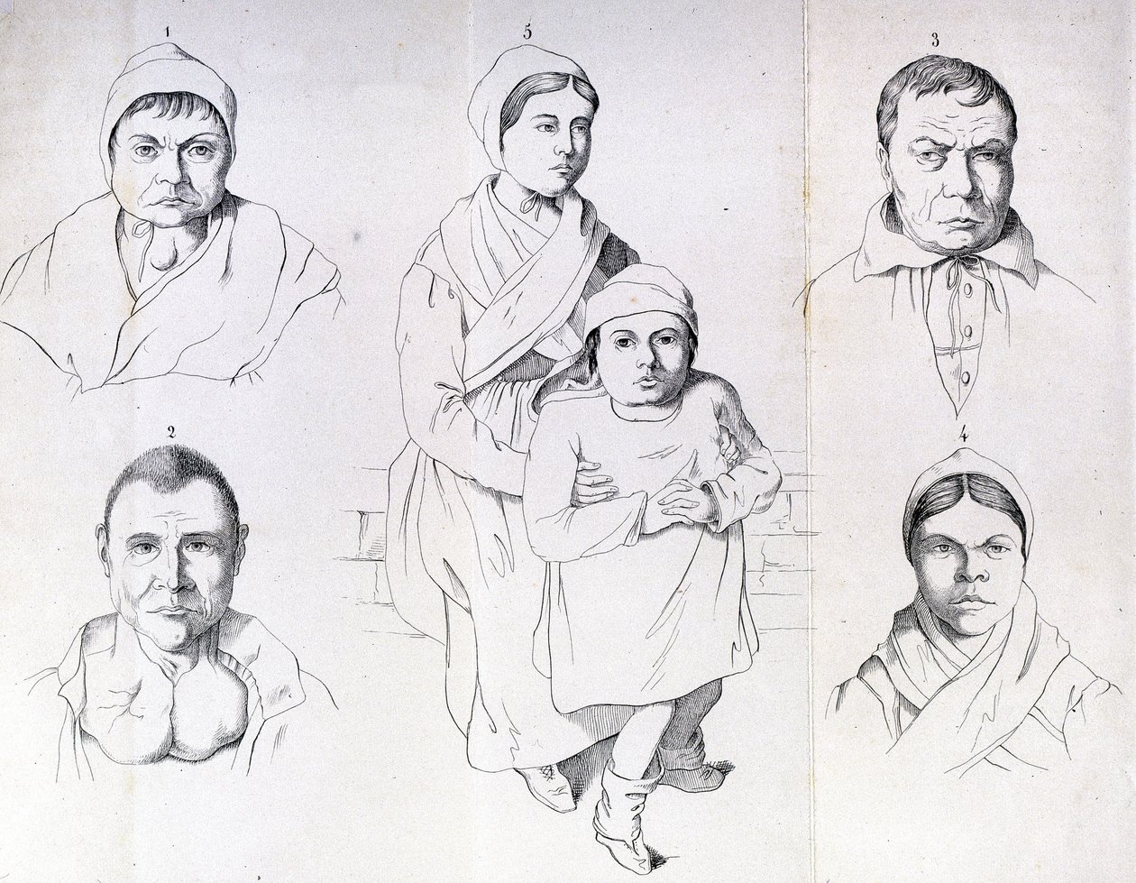 Överväganden om orsakerna till endemisk kretinism av Morel. av Unknown artist