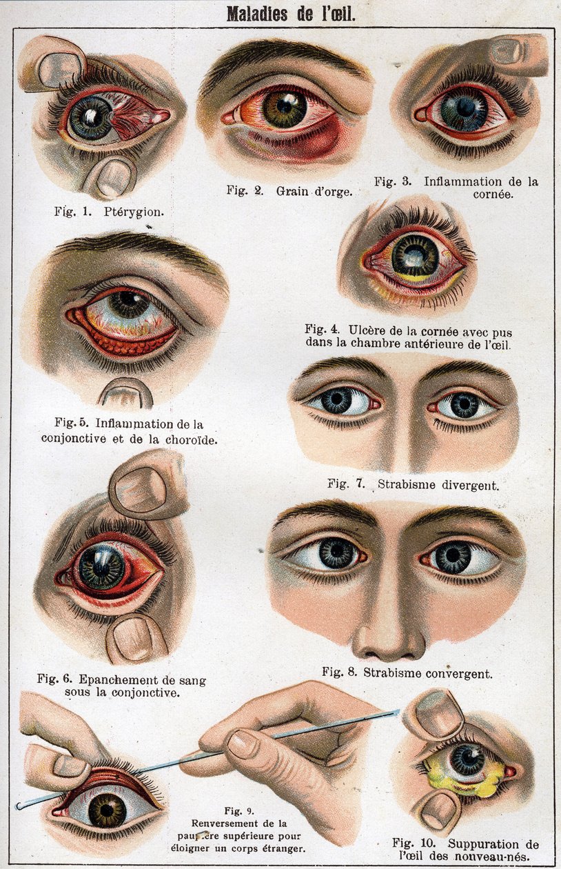 Sjukdomar i ögat. "Den nya naturmedicinen" av F.E. Bilz. av Unknown artist
